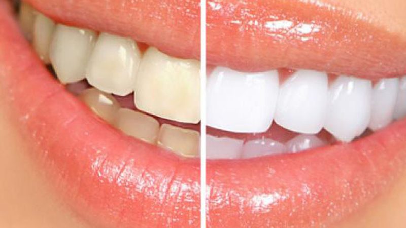 Teeth whitening at Clínica Goleta, Playa de San Juan