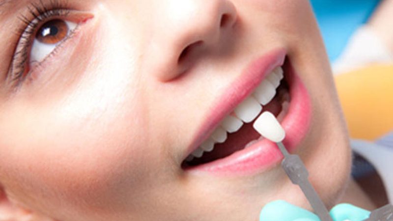 Dental veneers at Clínica Goleta, Playa de San Juan