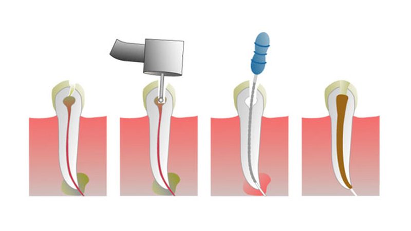 Root canal treatment at Clínica Goleta, Playa de San Juan