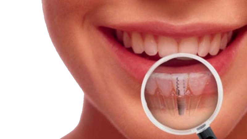 Dental implants at Clínica Goleta, Playa de San Juan