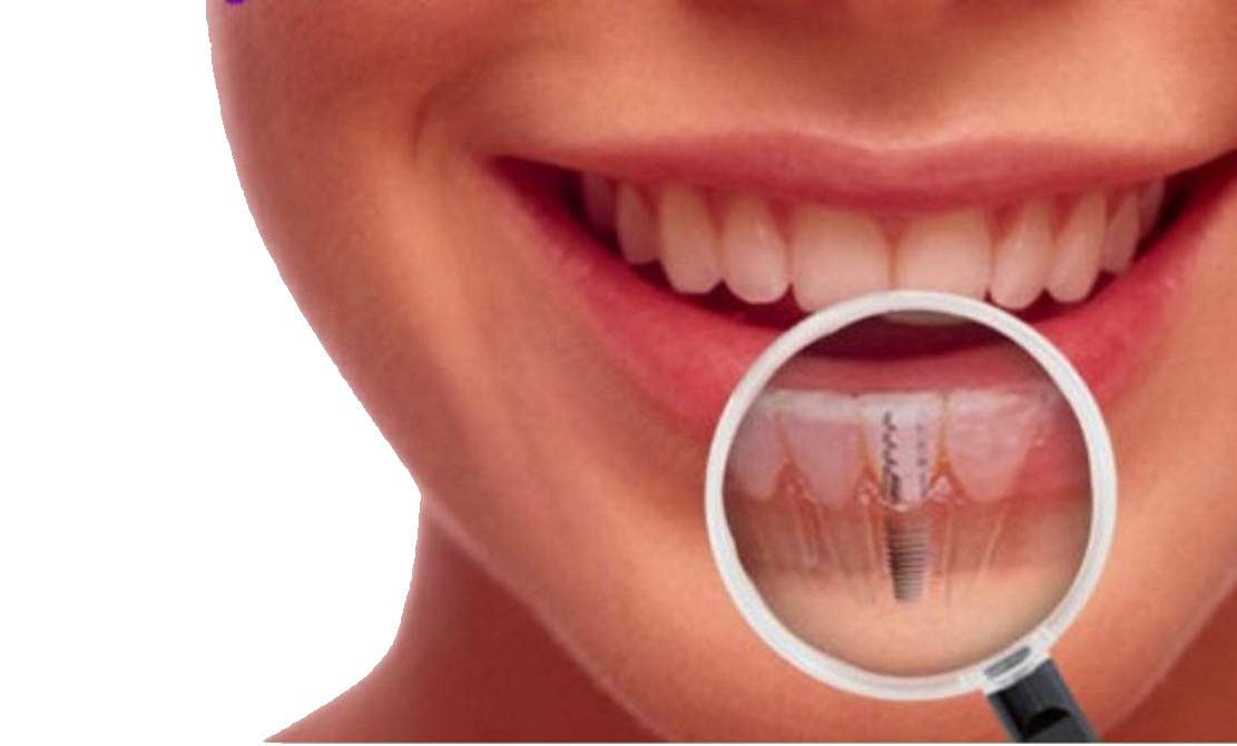 portada_implantes_dentales
